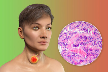 A 3D scientific illustration showcasing a woman with transparent skin, revealing a tumor in her thyroid gland, along with a micrograph image of thyroid cancer.