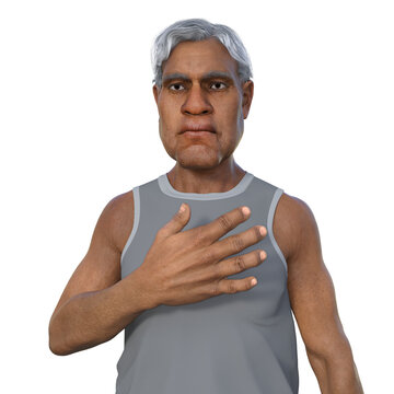 A man suffering from acromegaly, 3D illustration