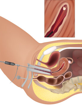 Uterine Polyps or Endometrial Polyps. Diagnostic Hysteroscopy. Procedure