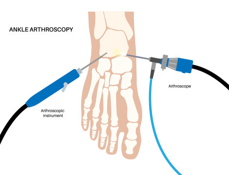 Ankle arthroscopy poster