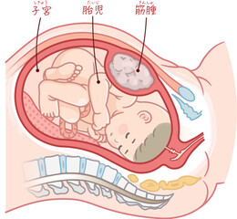 筋腫合併妊娠のイラスト、子宮筋腫、妊娠、子宮筋腫のある女性、胎児、赤ちゃん