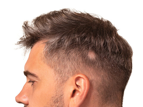 man with fashionable hairstyle and alopecia. white background