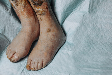 Legs of an elderly woman with varicose veins, scabbed wounds, varicose veins and thrombosis,...