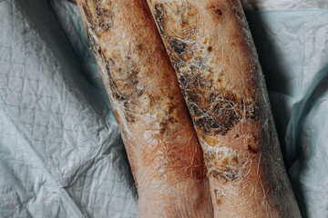Skin lesions on the leg. Symptoms characteristic of the elderly begin with a red rash in a small circle and spread to a wider area. Large scabs on the legs. Elderly care. Consequences of diabetes