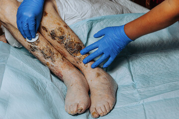 Skin lesions on the leg. Symptoms characteristic of the elderly begin with a red rash in a small...