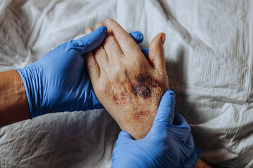 A bruise on the hand of an elderly person. Known as senile purpura. Caused by the fragility of the skin and blood vessels in old age. Elderly care