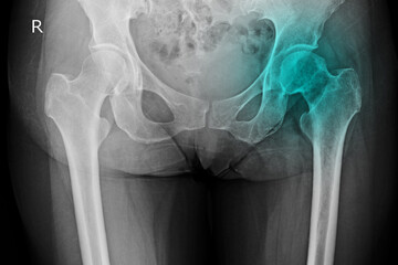 Pelvis and hip x-ray of a patient with hip pain showing avascular necrosis on the left sides of the hips and secondary osteoarthritis. The patient needed a total hip replacement. - obrazy, fototapety, plakaty