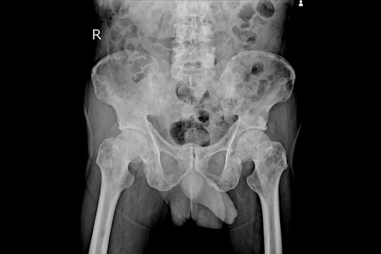 The radiography show metastasis cancer to pelvis and femur bone Medical healthcare concept.