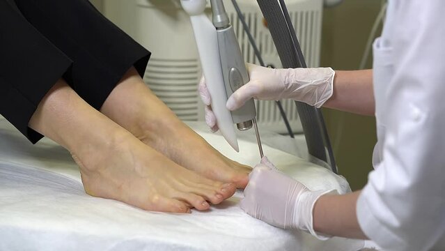 close up woman doctor doing laser treatment procedure for toenail fungus. Fungal infection on the nails. Treatment of onychomycosis with a medical laser