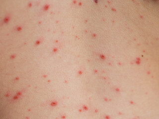 Close-up shot of a child body suffers from chickenpox (varicella). Full frame.