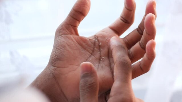 close up of Dry cracked skin of a men's hand 
