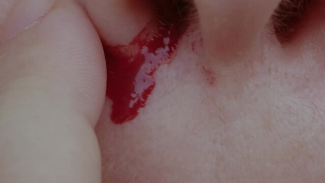 bright red blood flows from nostril, bright red blood flows from nostril, stop bleeding, epistaxis, close-up part of face, fragility of blood vessels, sharp increase in blood pressure