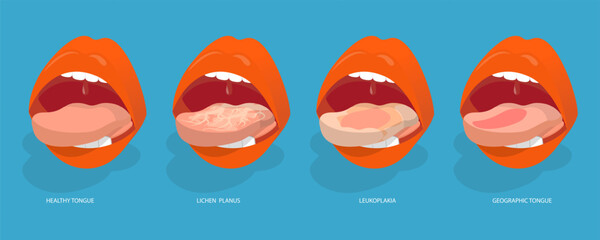 3D Isometric Flat Vector Conceptual Illustration of Sore Or White Tongue, Definition of the Disease by Tongue
