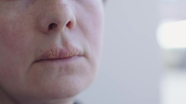 close-up herpes on female lips. unrecognizable woman suffering big herpetic virus disease mouth mucosa. upper lip covered ulcer swollen crusted pimples. viral symptom contagion facial herpes simplex