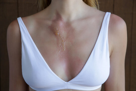 A second-degree burn with blister on woman's chest