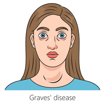 Woman with Graves' disease toxic diffuse goiter diagram schematic raster illustration. Medical science educational illustration