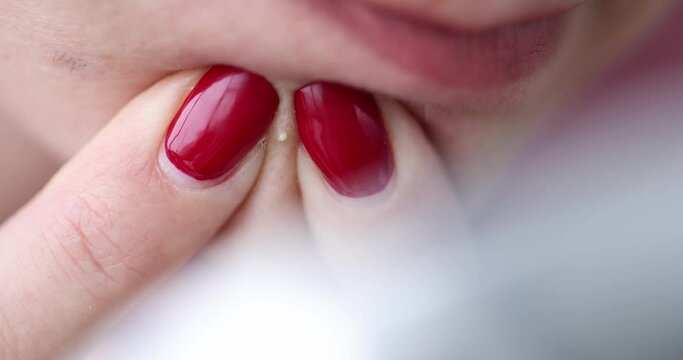 Young woman squeezing out pimple with her hands closeup 4k movie. Skin care concept