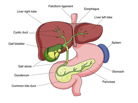 Gallstone structure stone gallbladder diagram schematic vector illustration. Medical science educational illustration