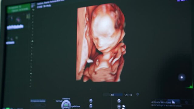 Ultrasonic image of a baby in mother's womb. Diagnostics of pregnancy at hospital. Close up.