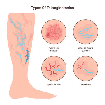 Telangiectasia types set. Varicose veins pattern, dilated blood vessels
