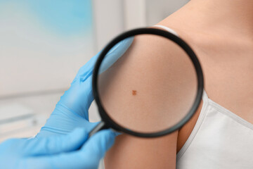 Dermatologist examining patient's birthmark with magnifying glass indoors, closeup