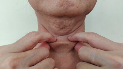 close up the flabbiness adipose sagging skin under the neck, wattle and cellulite under the chin of...