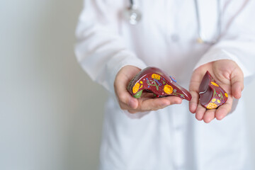 Doctor holding human Liver anatomy model. Liver cancer and Tumor, Jaundice, Viral Hepatitis A, B, C, D, E, Cirrhosis, Failure, Enlarged, Hepatic Encephalopathy, Ascites Fluid in Belly and health - obrazy, fototapety, plakaty
