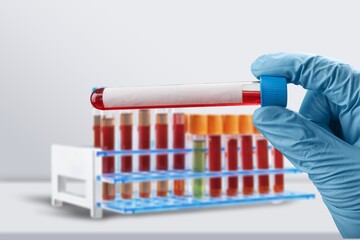 Doctor hand hold blood sample