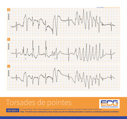 Naklejka premium A 4-year-old boy with a clinical diagnosis of long QT syndrome. No genetic testing was done during hospitalization. The child died suddenly during follow-up.