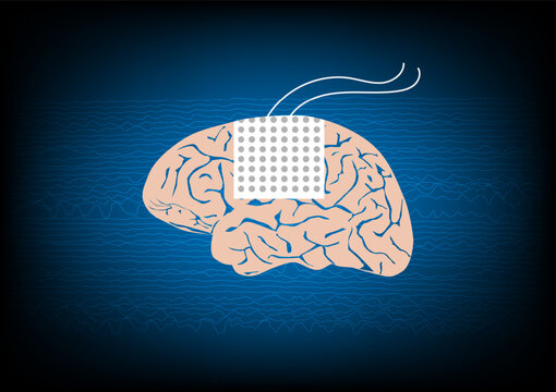 Illustration of subdural electrode over brain surface for EEG or brain waves monitoring in epilepsy surgery.
