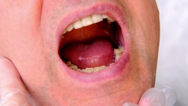 closeup female hands, dentist, doctor examines oral cavity of patient with tools, mirror, charismatic mature man 60 years old with open mouth, close up of mouth, tooth enamel is heavily worn