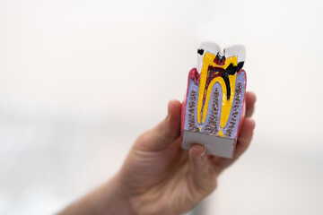 Dentist hand holding plastic model of human tooth stricken with caries on light background doctor demonstrating destructive effect of disease to student