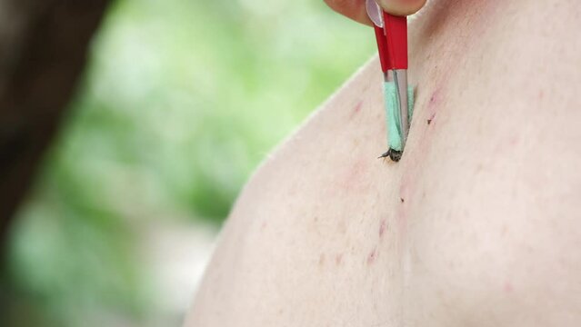 Apitherapy. With the help of tweezers, the bee is placed on the skin of a person and deliberately forced to sting. Bee stings for health and healing. Treatment of arthritis with bee venom
