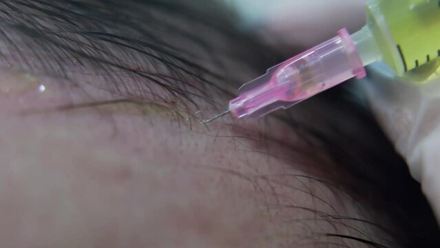 Macro shot of Hair mesotherapy procedure in the modern cosmetology clinic, plasma injectiions. Middle aged male patient prp procedure for hair regrowth