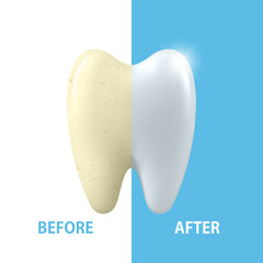 Vector Banner with 3d Realistic Tooth Closeup. Cleaning Concept - Before and After Hygienic Teeth Cleaning. Dentistry Design. Medical, Toothpaste Advertisement. Healthy Oral Hygiene, Teeth Whitening