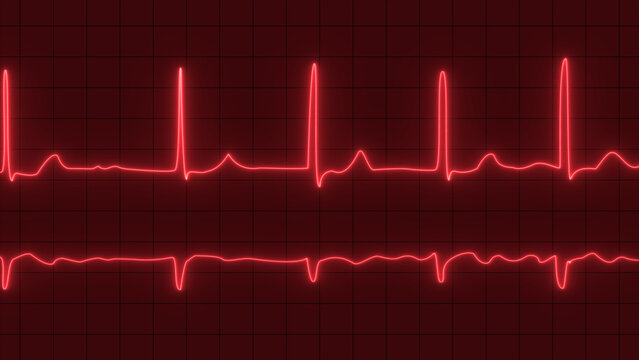 ECG with supraventricular premature beats and short paroxysms of neon atrial fibrillation. Close up of electrocardiogram chart background
