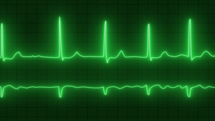 ECG or EKG pulse heartbeat green line symbol on black background. fibrillation. ECG with brief paroxysms of supraventricular extrasystole and neon atrial fibrillation.