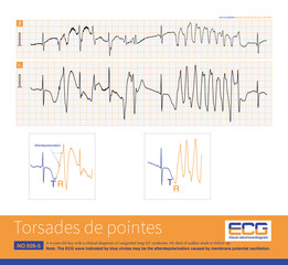 A 4-year-old boy with a clinical diagnosis of long QT syndrome. No genetic testing was done during hospitalization. The child died suddenly during follow-up.