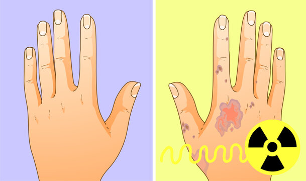 Effects of radiation on human health. Skin lesion. Healthcare illustration, medical illustration. Vector illustration. 
