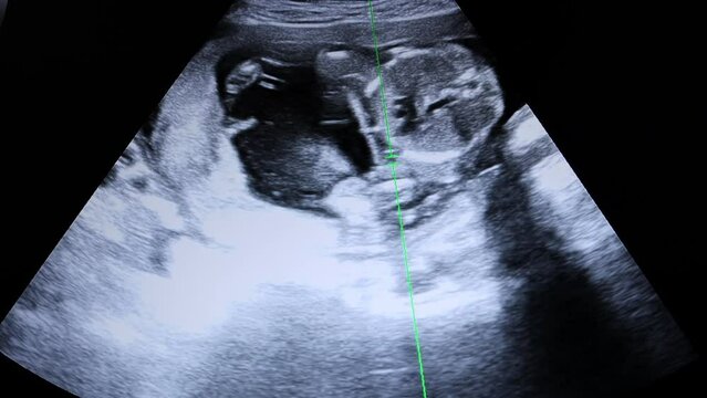 graph of the child's heartbeat on the equipment. screening of the pregnant screen of the monitor. screenshot of the screen. ultraviolet