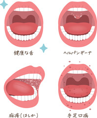 tongue,koplik spots,measles,hand-foot-and-mouth disease,illustration,