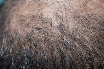 Close up of bald spot on Asian men's head with white hair and dandruff problem. Conceptual of hair problem on men's head.