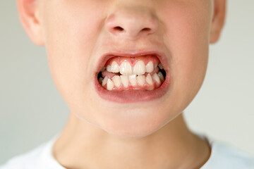 An open mouth revealing a child's crooked teeth. Dental Medicine and Health