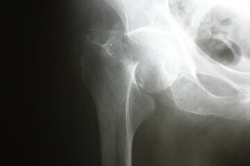 Surgical plates for osteosynthesis in case of bone fractures	