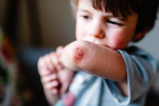 Little boy shows skinned elbow