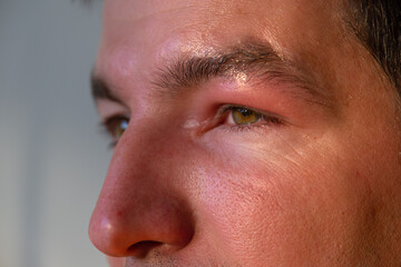 Fototapeta premium A red swollen eyelid on a man's face in close-up is an allergy to an insect bite. Allergic reaction to blood-sucking insects