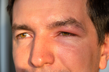 A red swollen eyelid on a man's face in close-up is an allergy to an insect bite. Allergic reaction...
