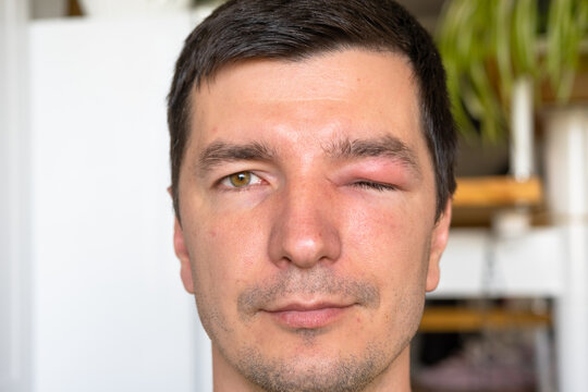 A red swollen eyelid on a man's face in close-up is an allergy to an insect bite. Allergic reaction to blood-sucking insects