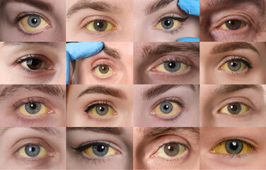 Yellowing of eyes as symptom of hepatitis. Collage with photos of people