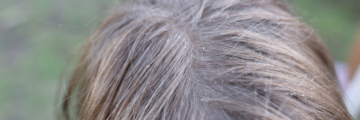 Drops of water or dandruff on childs hair